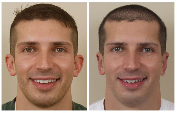 Get Otoplasty for Improved Ear Shape and Symmetry