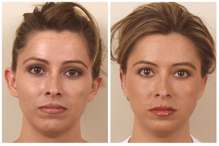 Otoplasty to Correct Protruding or Misshapen Ears