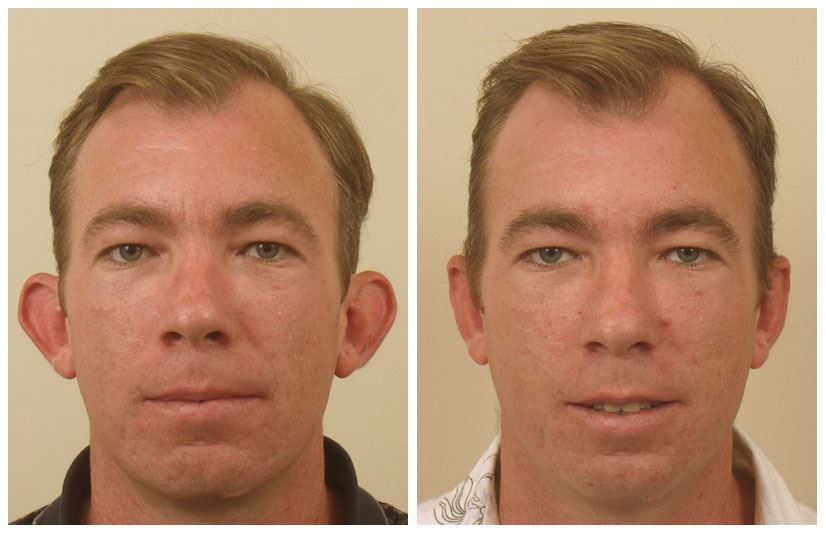 Otoplasty Surgery for Balanced, Natural-Looking Ears