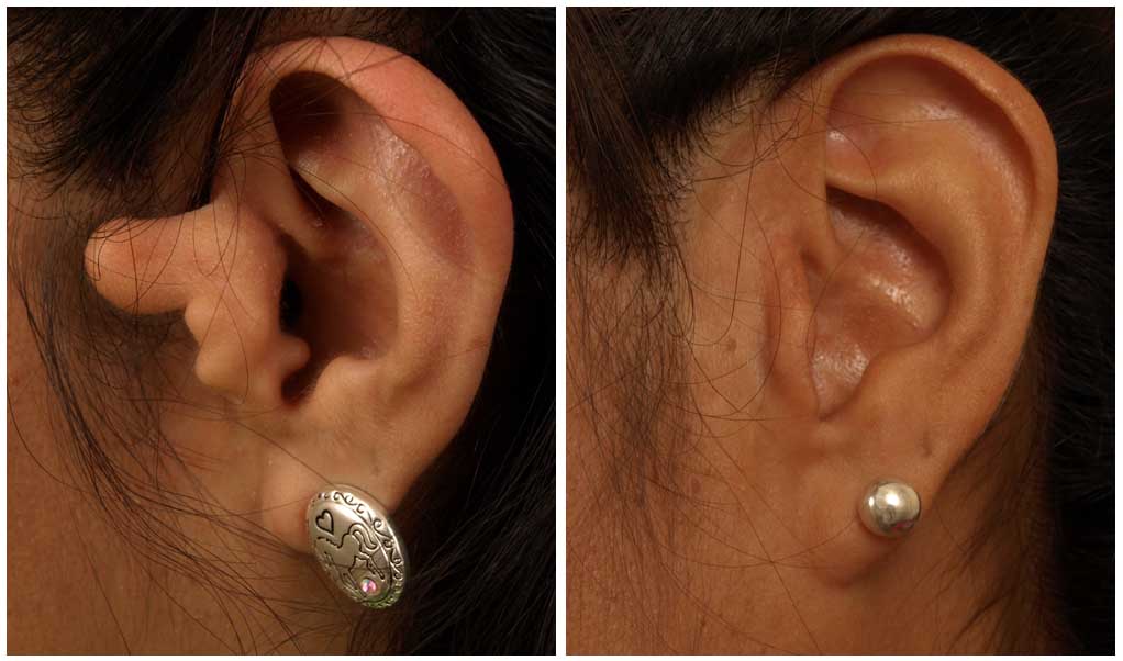 Otoplasty for Correcting Protruding or Large Ears