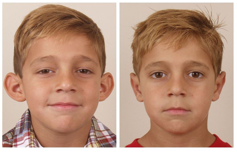 Improve Ear Shape with Otoplasty Surgery