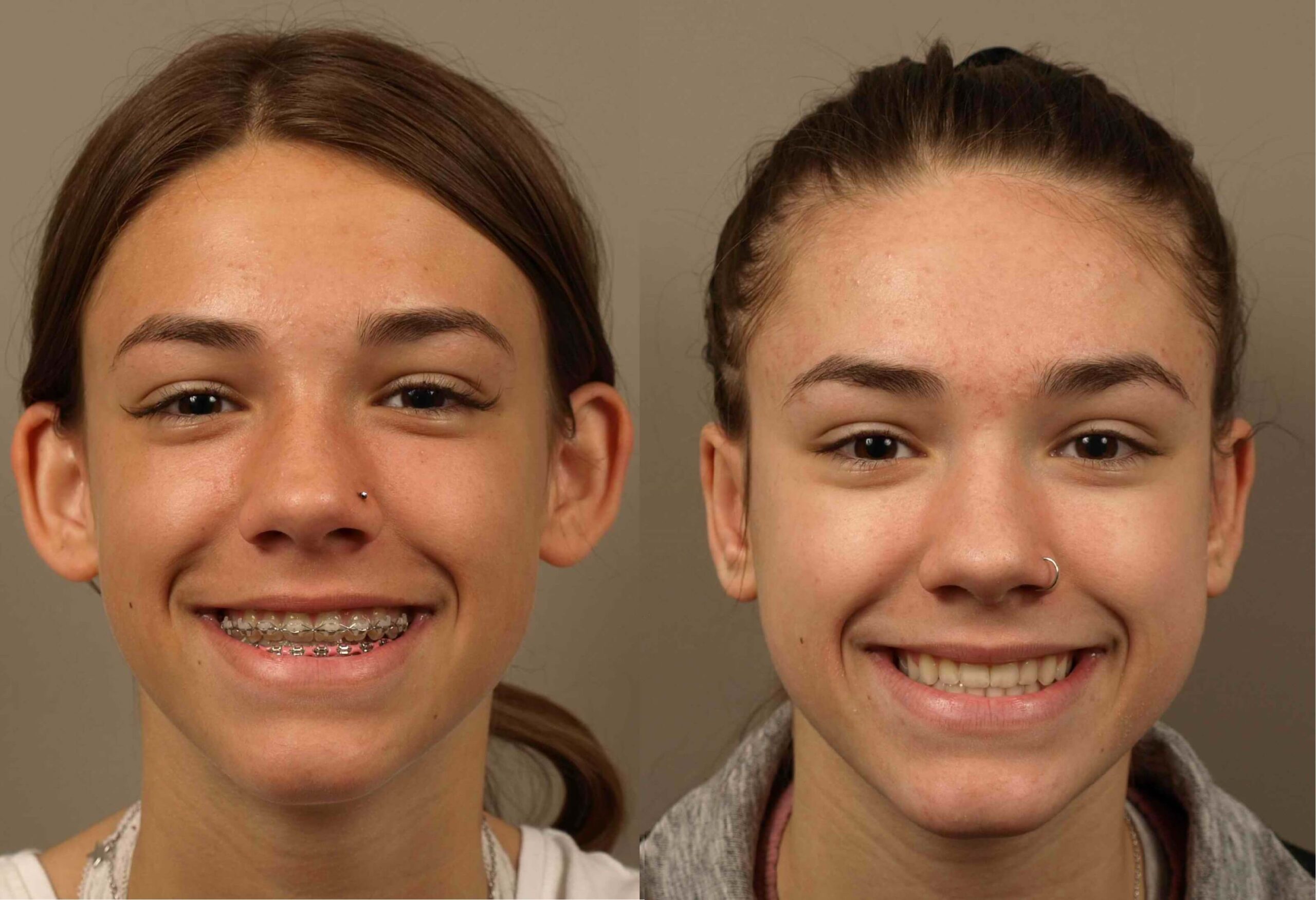 Enhance Ear Appearance with Otoplasty