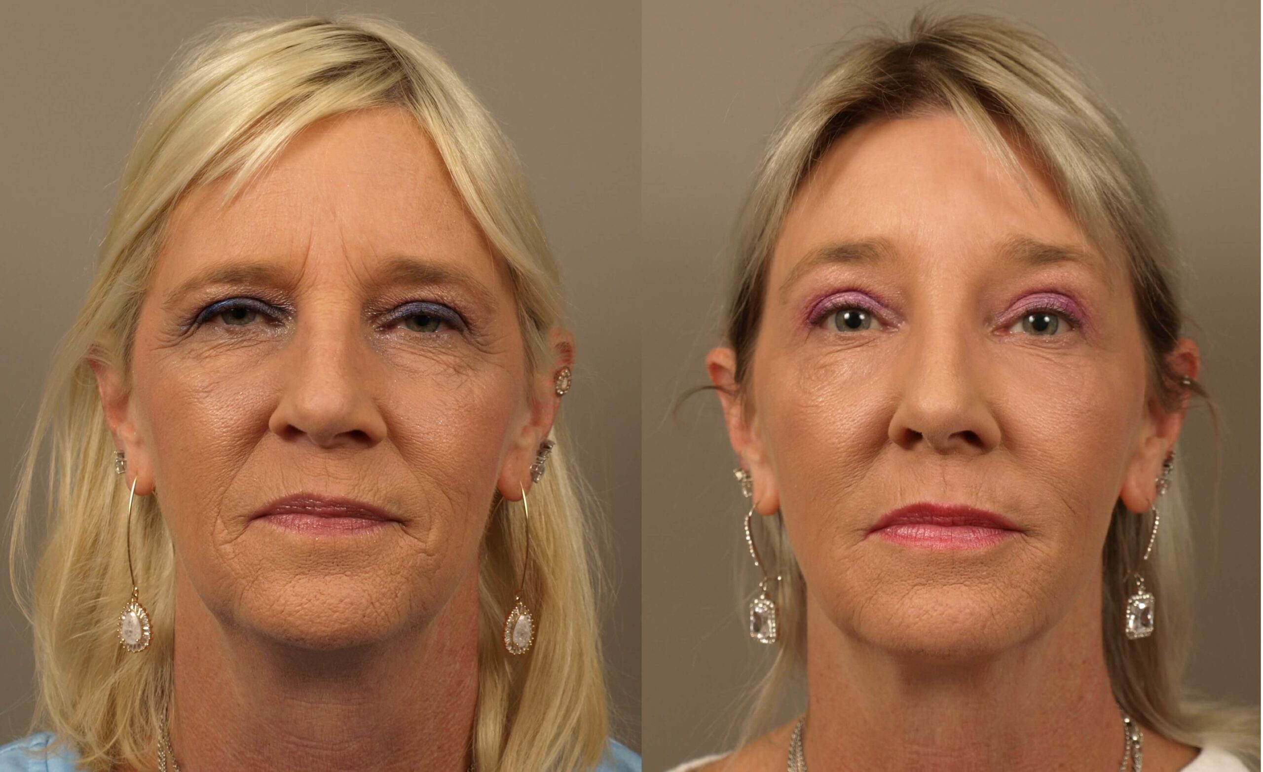 Get Clear, Healthy Skin with Laser Skin Resurfacing