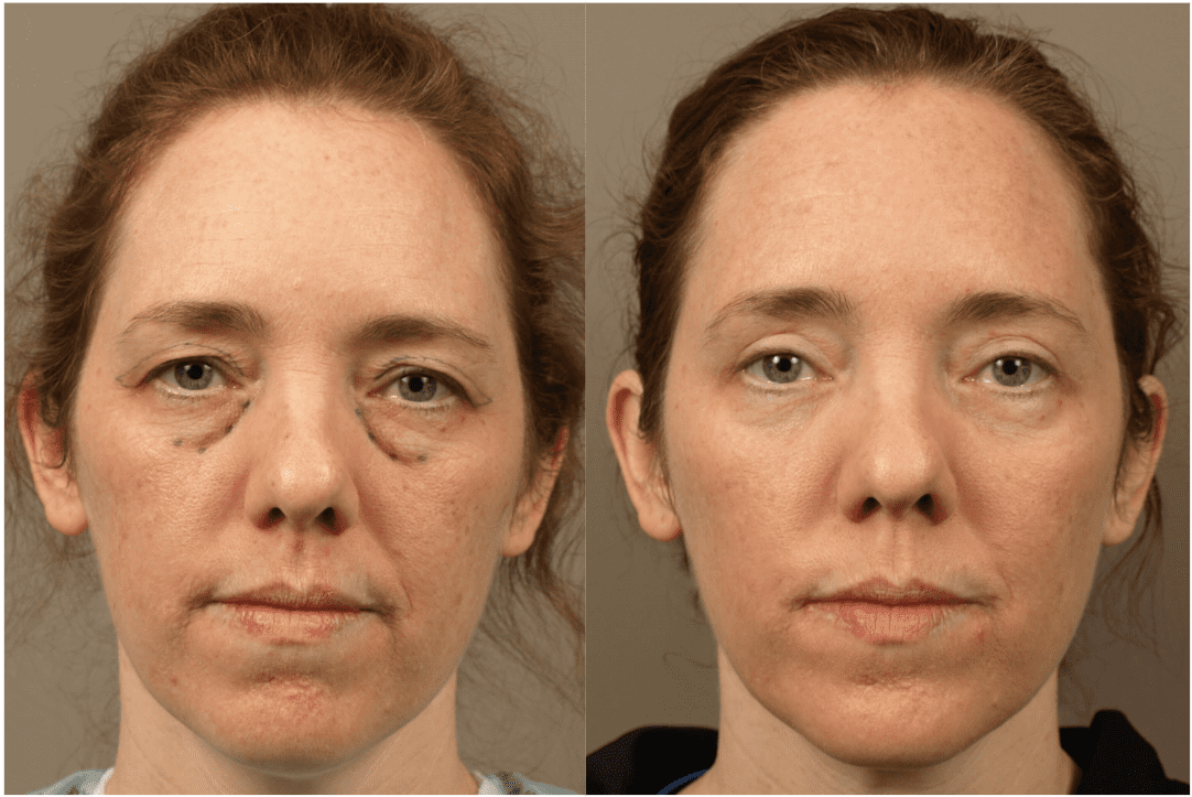 Restore Volume with Tear Trough Implants