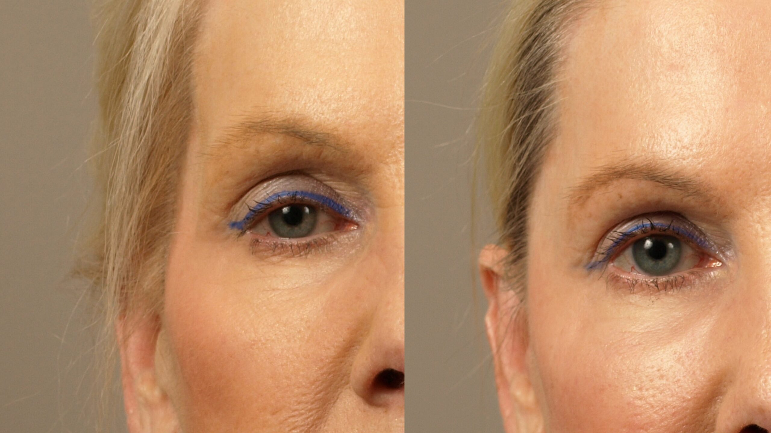Enhance Your Facial Features with Template Implant