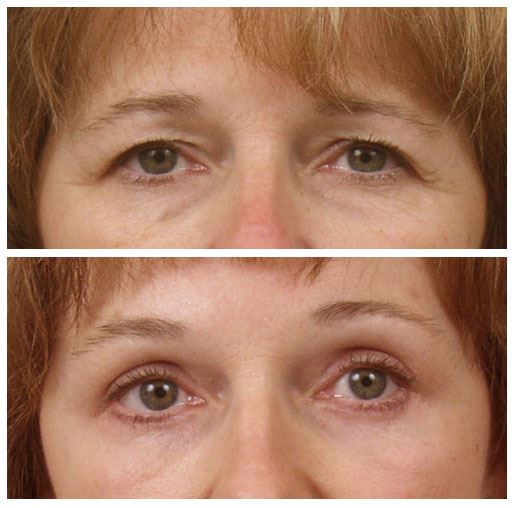 Brow Lift & Laser Resurfacing for Refreshed Eyes
