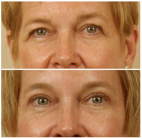 Get Youthful Skin with Brow Lift & Laser Resurfacing