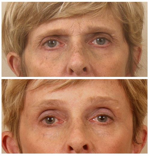 Upper Eyelids & Browlift with Removal of Scowl Muscle. Creases Between the Eyebrows has Softened without Need for Botox