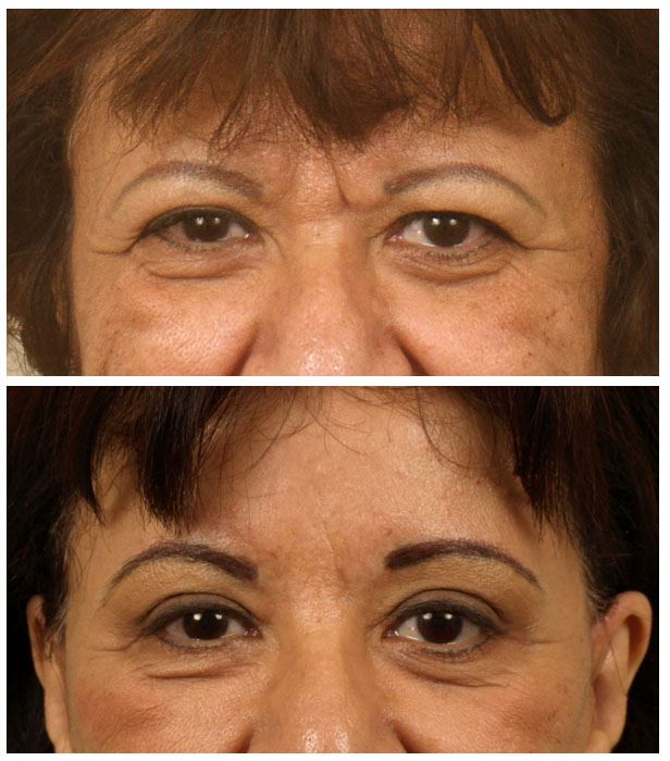 Brow Lift & Laser Resurfacing for Younger, Firmer Skin