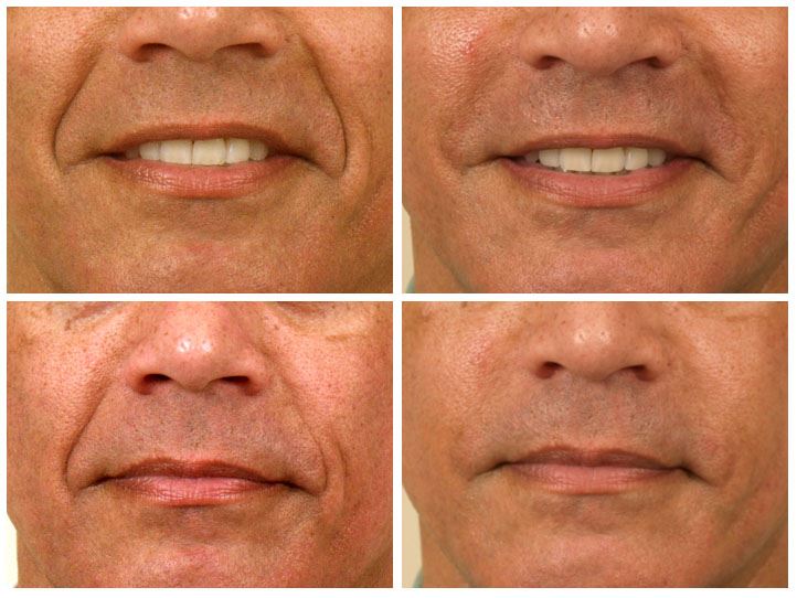 Wrinkle Fillers for a Younger, Refreshed Look