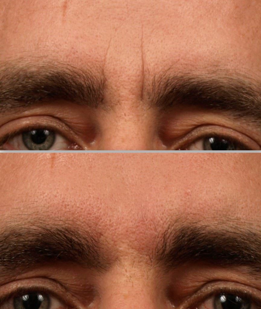 Get Wrinkle Fillers for a Youthful Appearance