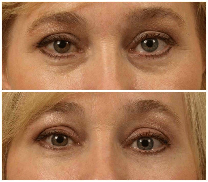 Wrinkle Fillers for Lasting Youthful Results