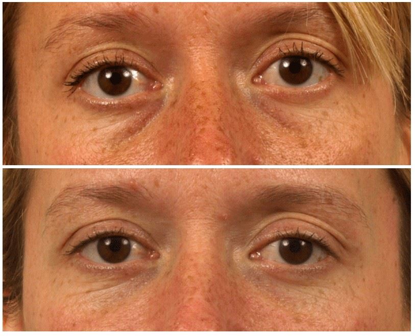 Wrinkle Fillers to Restore Facial Volume