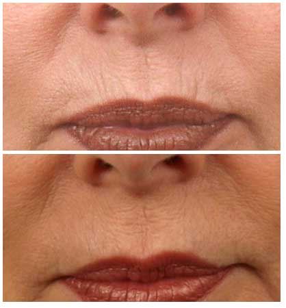 Reduce Wrinkles with Effective Dermal Fillers
