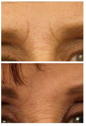 Smooth Lines with Advanced Wrinkle Fillers
