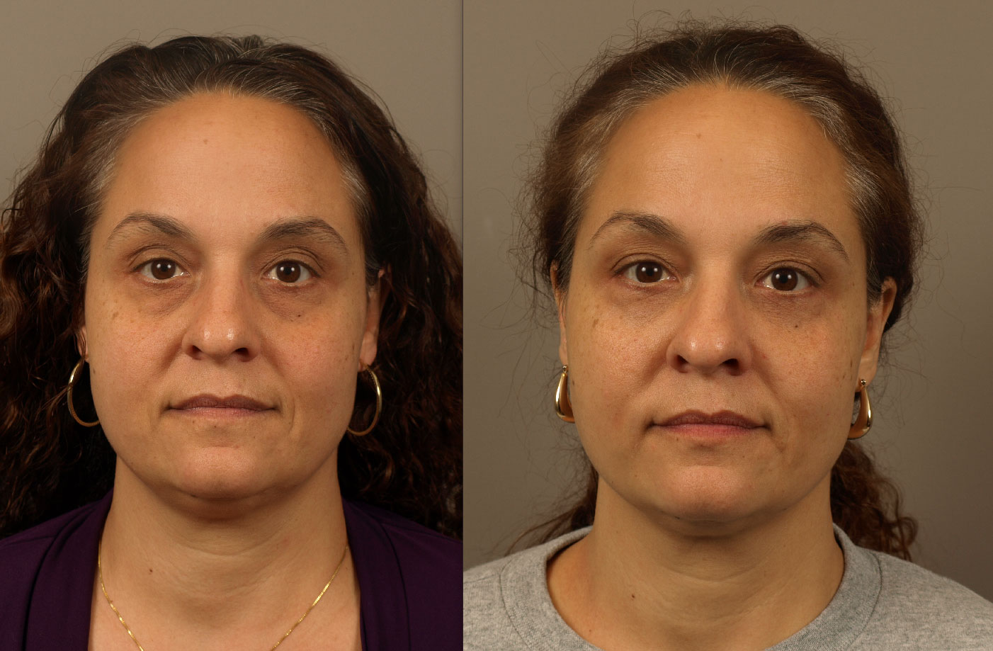 Tear Trough Implant | Blepharoplasty for Youthful, Refreshed Eyes
