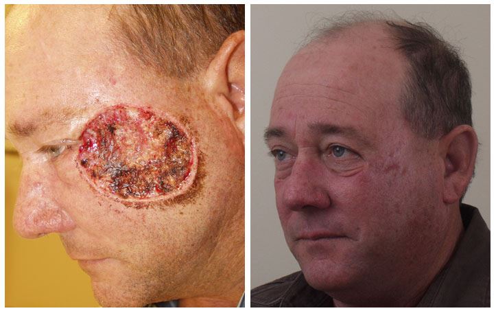 Facial Reconstruction After Cancer Treatment