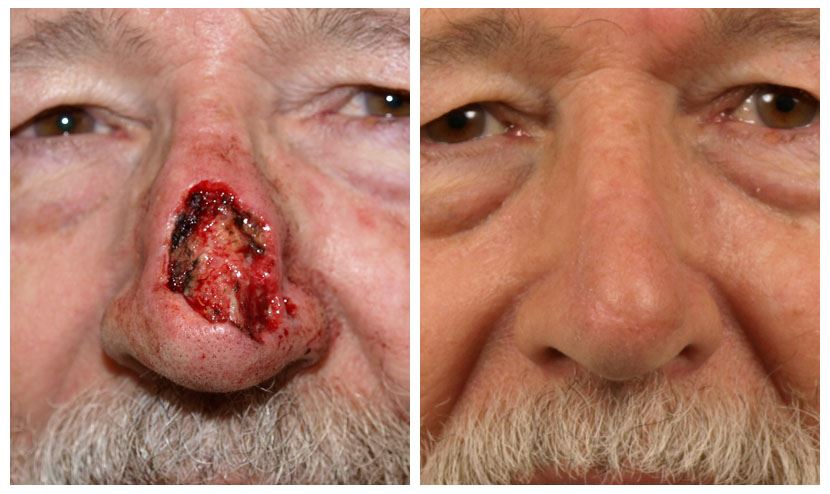 Nasal Reconstruction Surgery for Functional Restoration