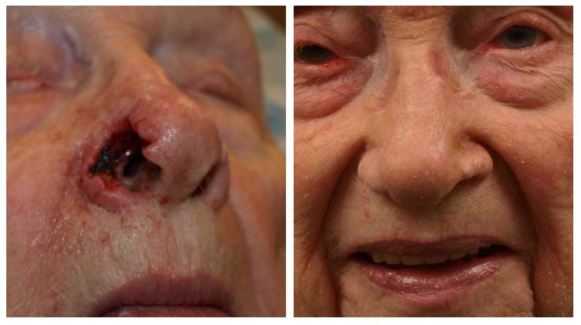 Get Nasal Reconstruction for Restored Nose Shape