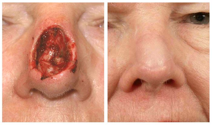 Nasal Reconstruction for Improved Function and Form