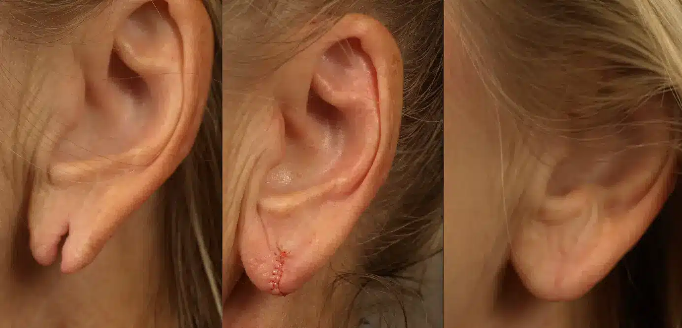 ear lobe repair