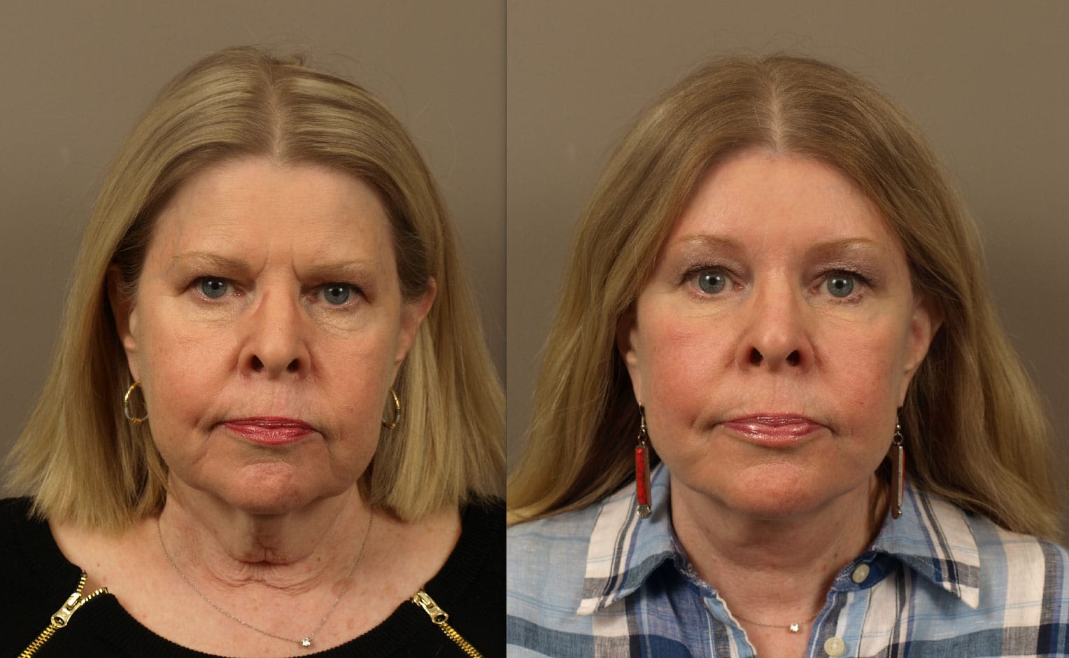 Before and After Facelift | Facelift for a Youthful, Refreshed Appearance
