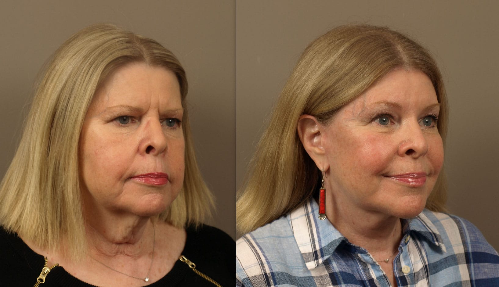 Before & After of Facelift Procedure | Facial Plastic Surgeon in Texas for Natural Results