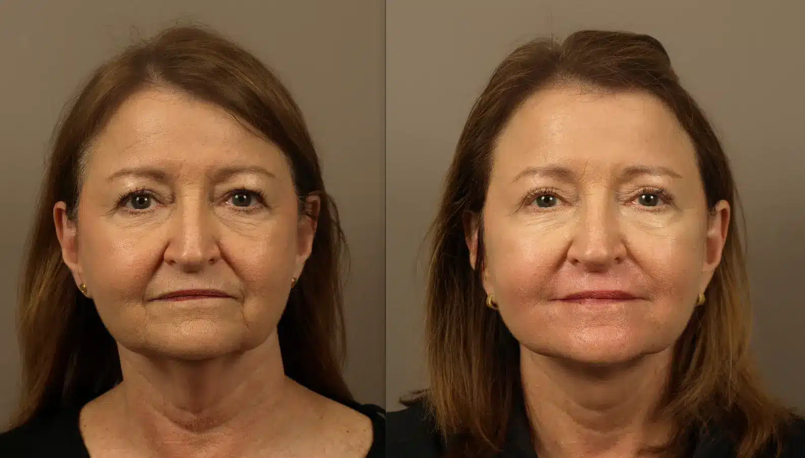 Deep plane facelift patient, front view, one year post-surgery