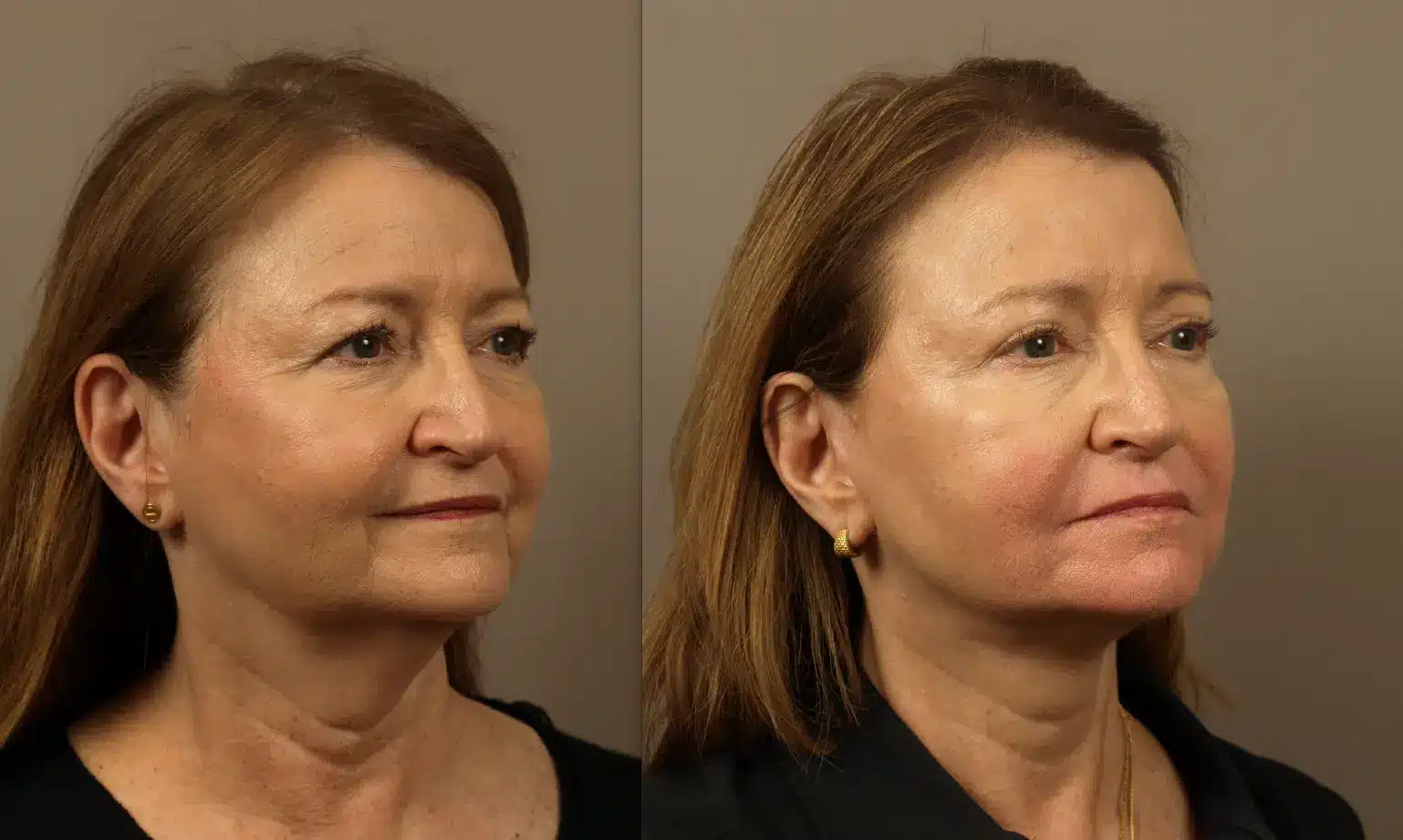 Deep plane facelift patient, oblique view, one year post-surgery