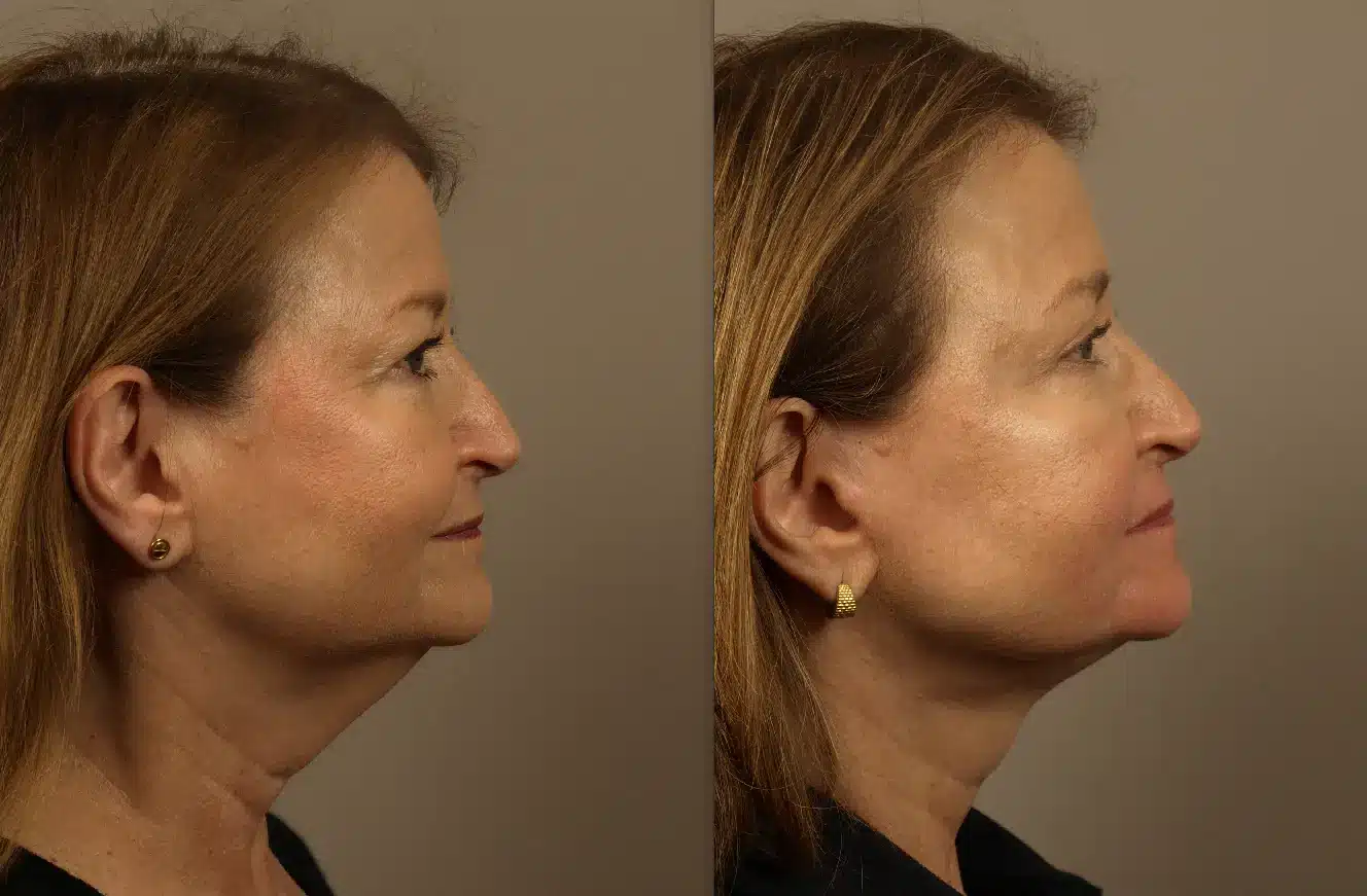 Deep plane facelift patient, side view, one year post-surgery