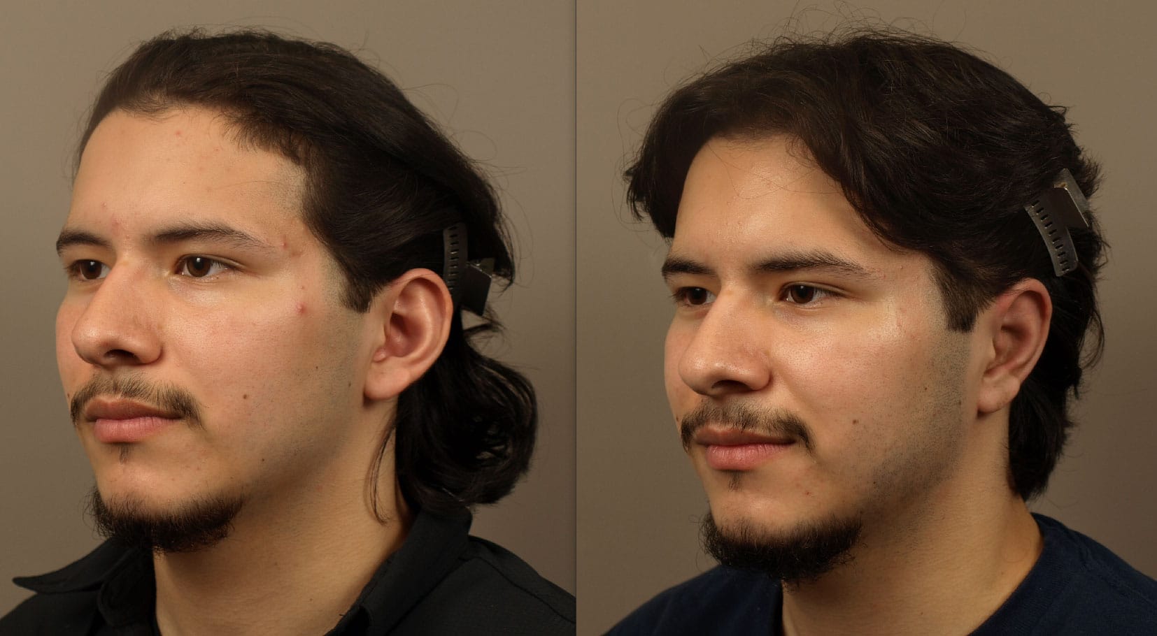 Before and After Otoplasty Procedure | Otoplasty: Ear Surgery for a Balanced Look