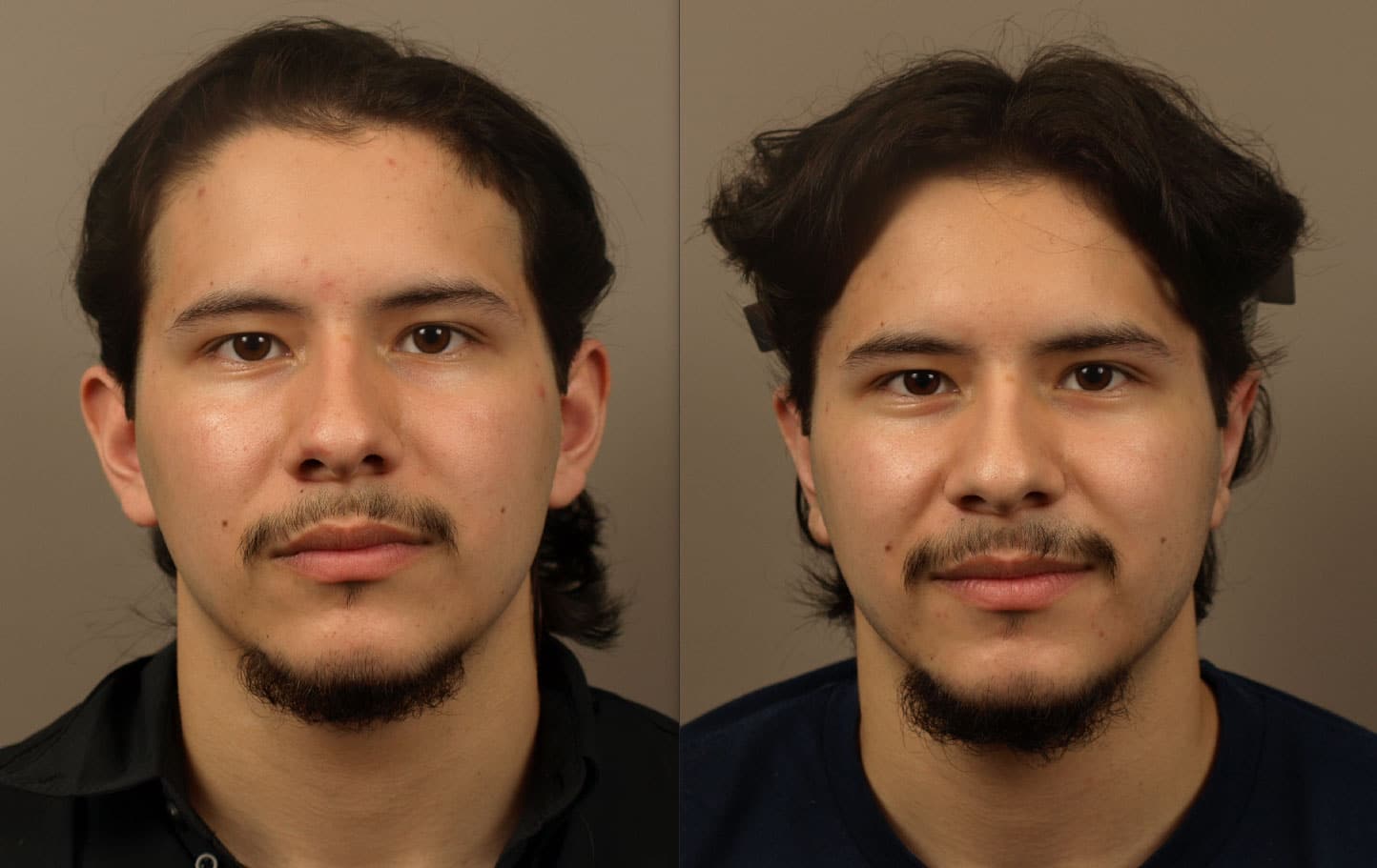 Before & After Otoplasty Procedure | Otoplasty for Improved Ear Shape and Position