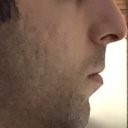 Sliding Genioplasty for Chin Reshaping and Balance