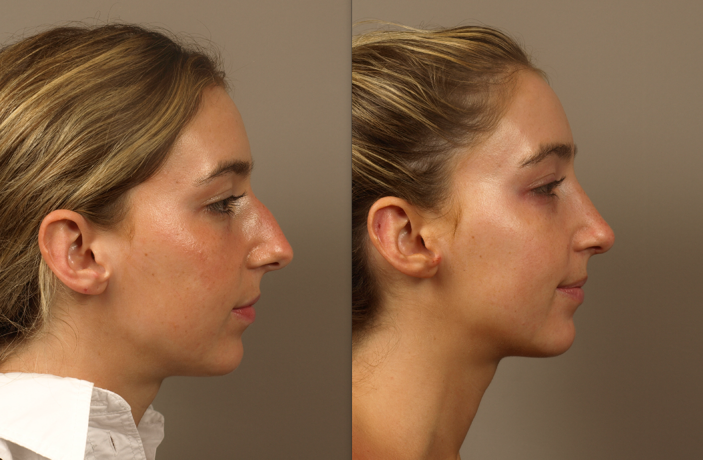 rhinoplasty