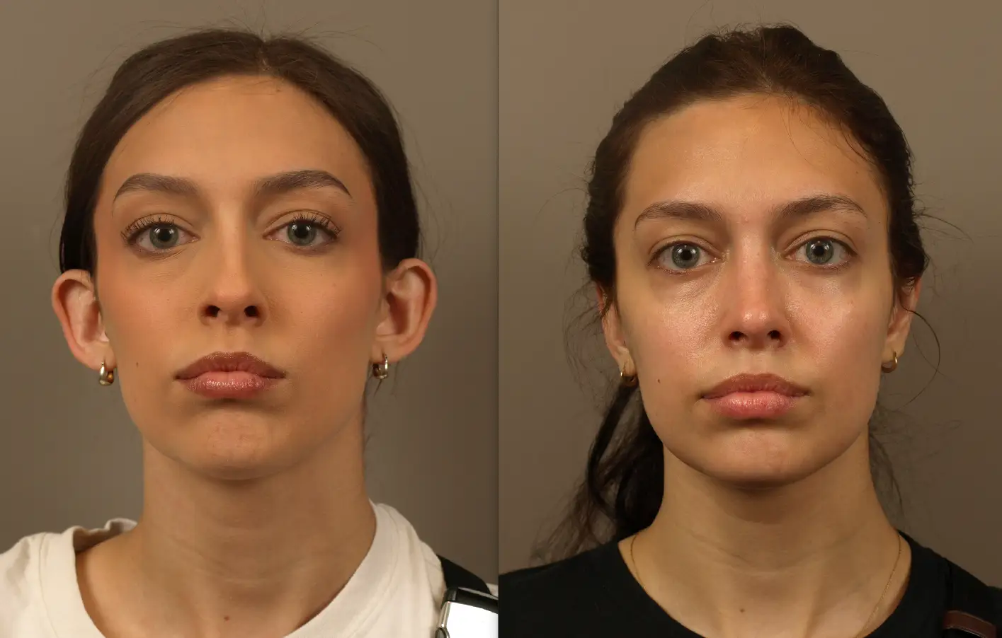 Before and After Otoplasty Procedure | Otoplasty: Ear Surgery for a Balanced Look