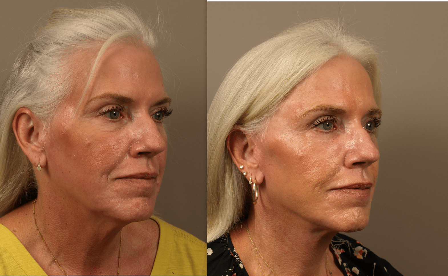 Facelift patient 3/4 oblique view, 6 months post-surgery
