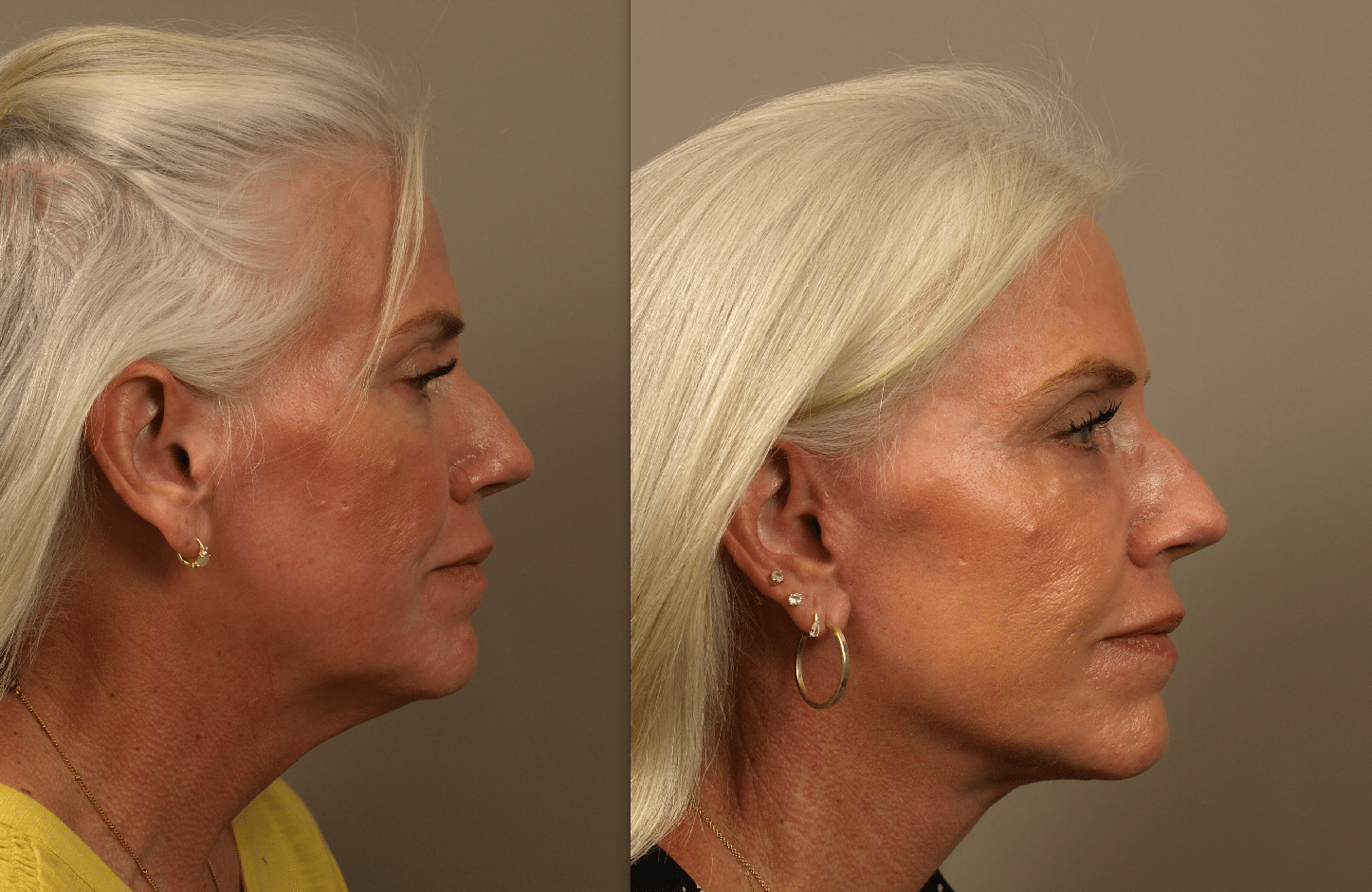Facelift patient side view, 6 months post-surgery